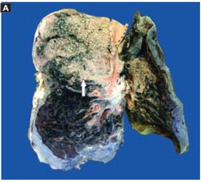 Lobar pneumonia