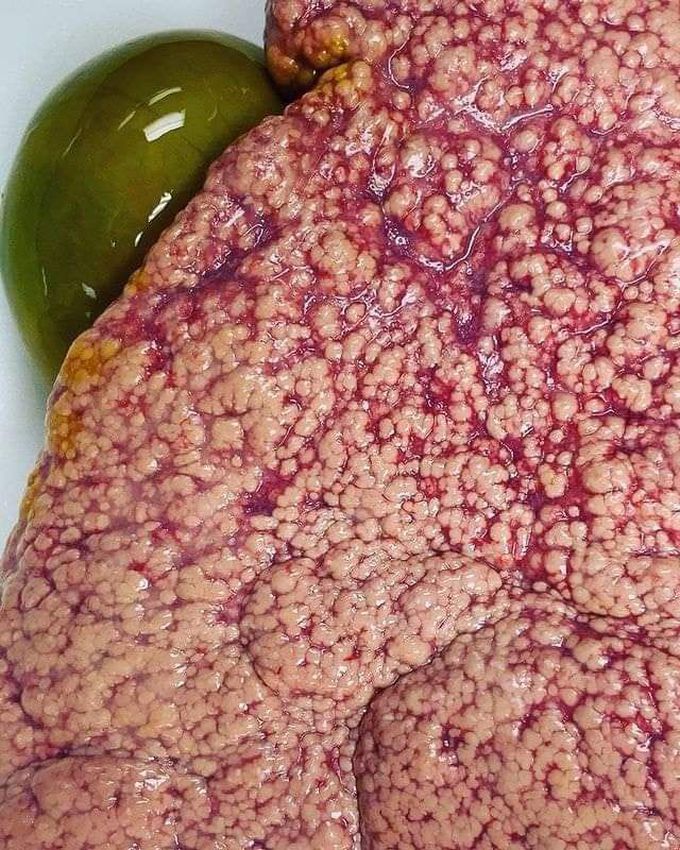 A classic example of liver cirrhosis 👣😮