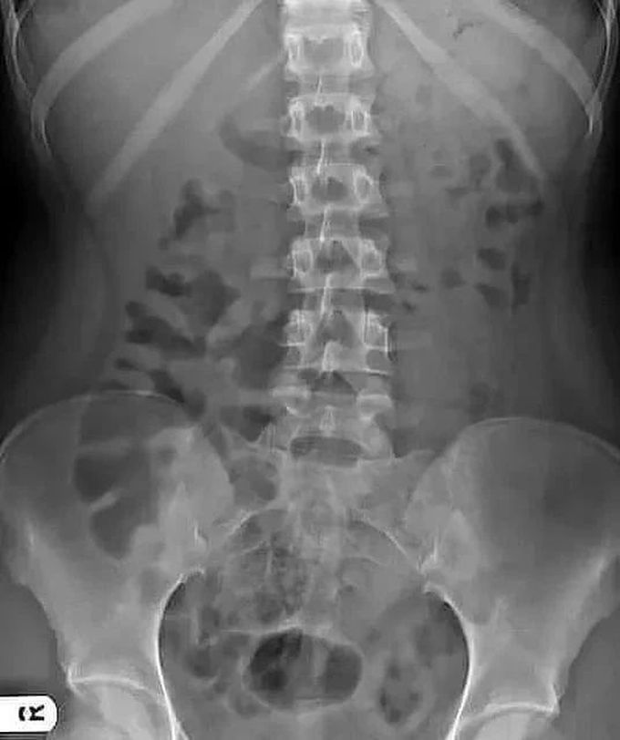 Identify the Radiographical Finding