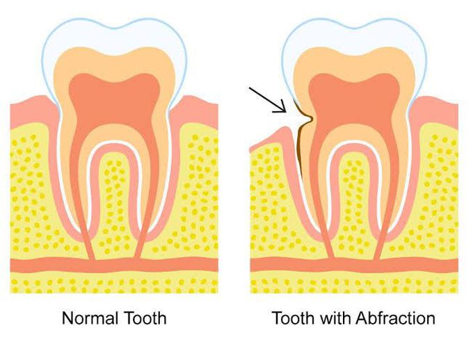Dental abfraction