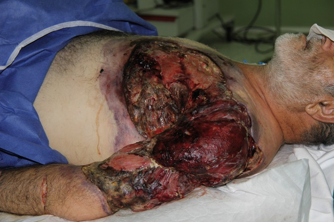 Necrotising Fasciitis Of The Upper Extremity