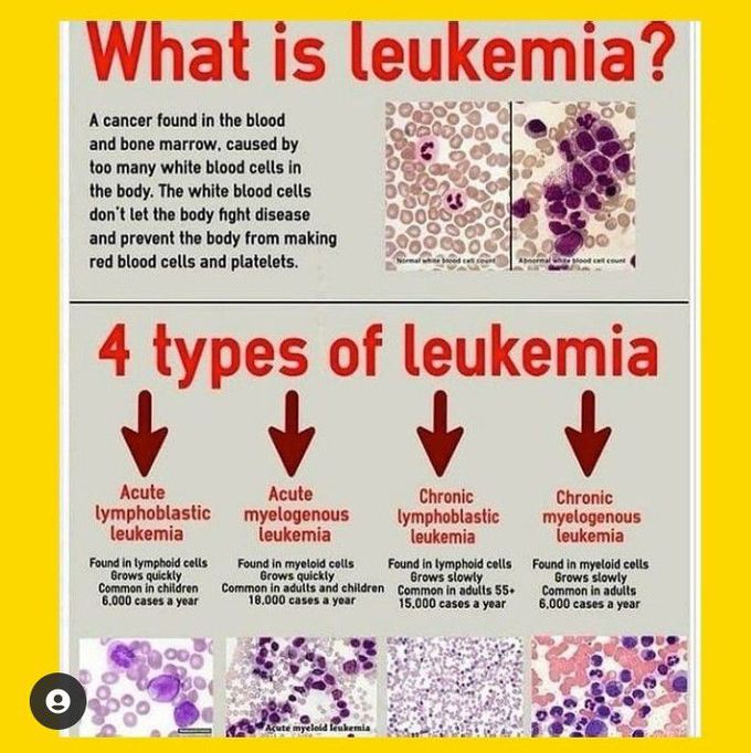 Leukemia and its types