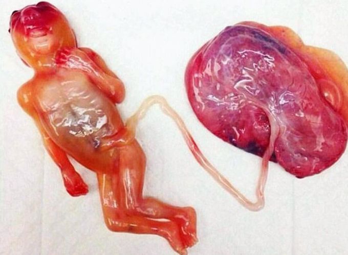 Spantaneous abortion of a fetus with anencephaly