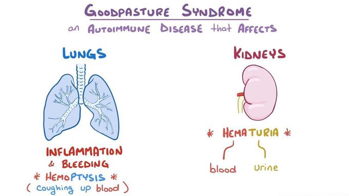 Goodpastures syndrome