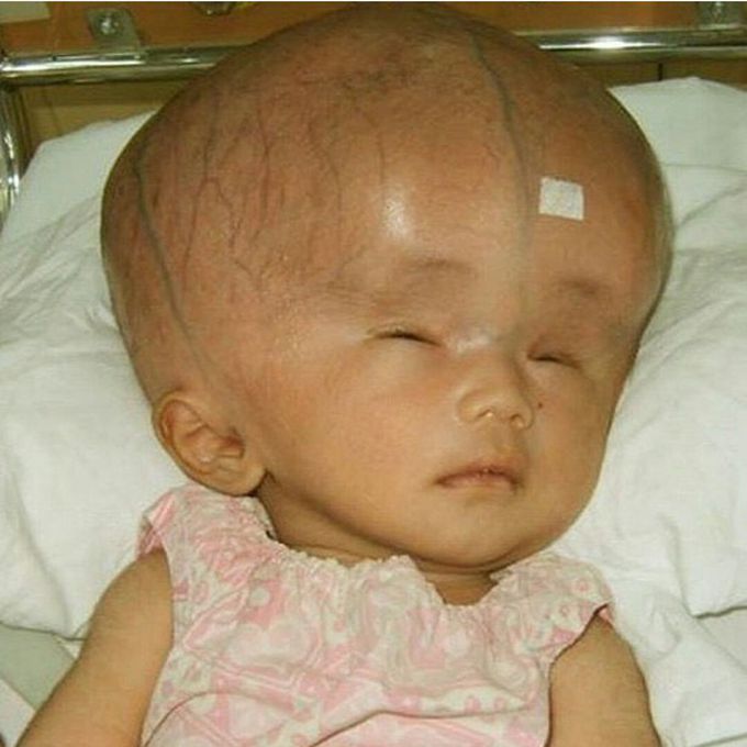 Hydrocephalus