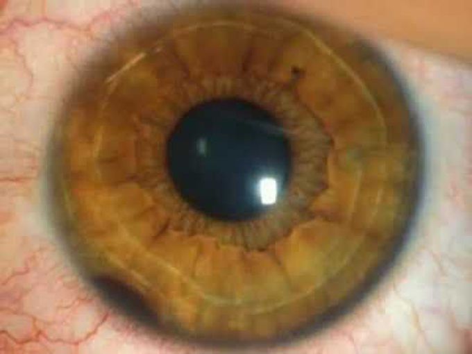 Eye Surgery (Tumor)