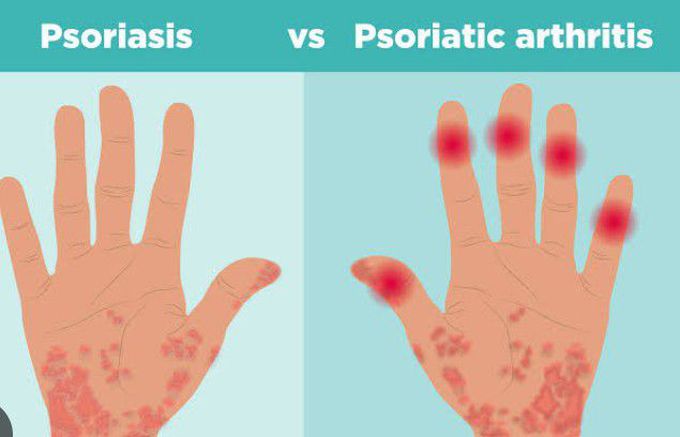 Psoriatic arthritis