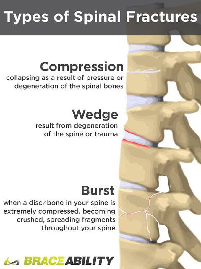 Types of Spinal Fractures