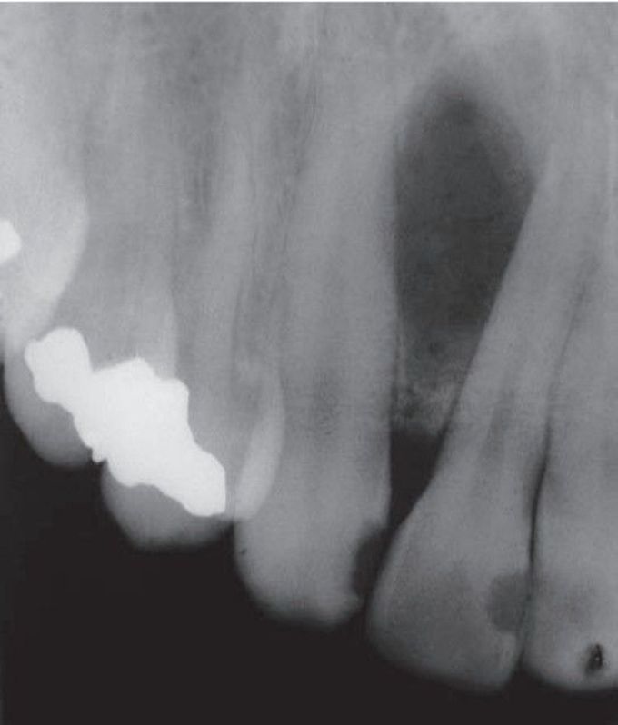 Globulomaxillary cyst