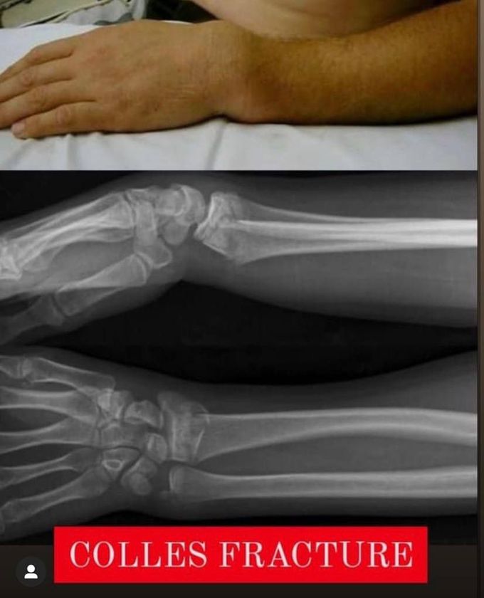Colles fracture