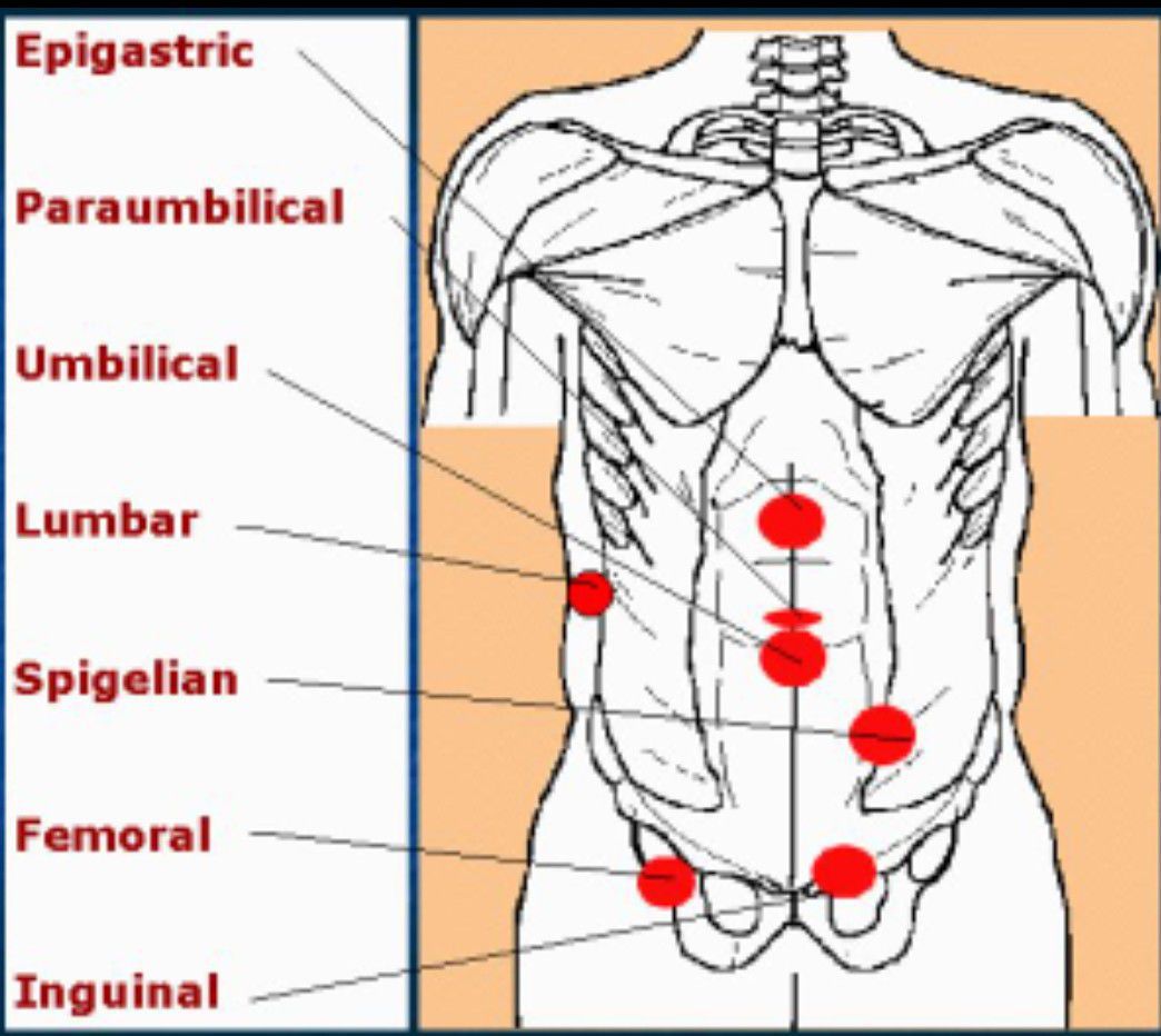 Hernia - MEDizzy