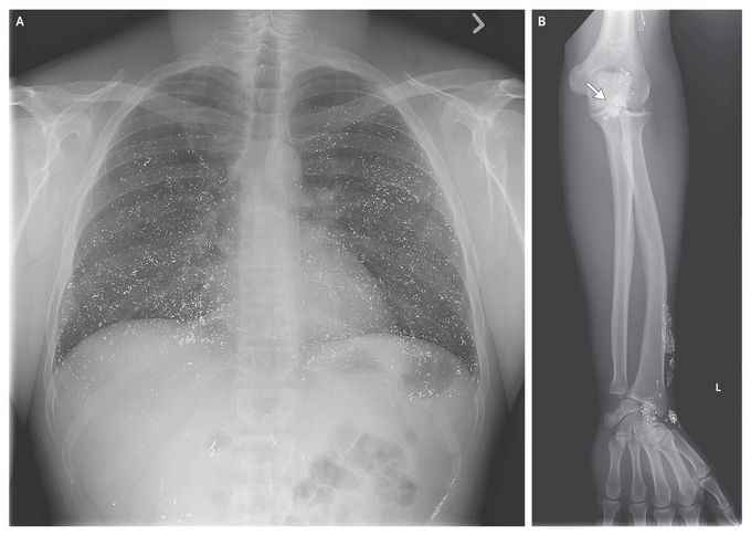Pulmonary Emboli Caused by Mercury