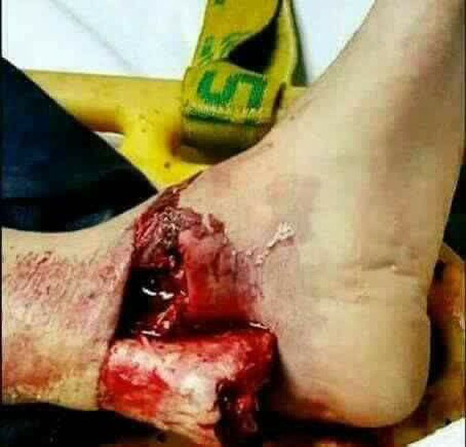 Compound fracture