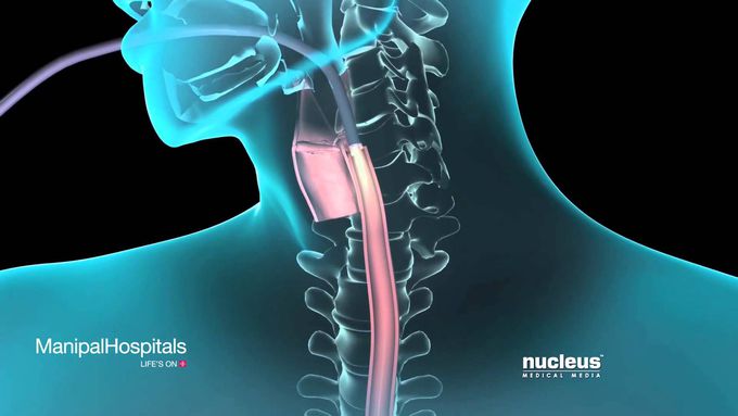 What Is The Procedure For An Endoscopy? – Manipal Hospital