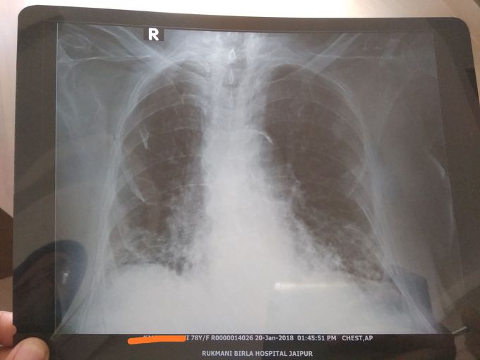 What are the findings in the CXR