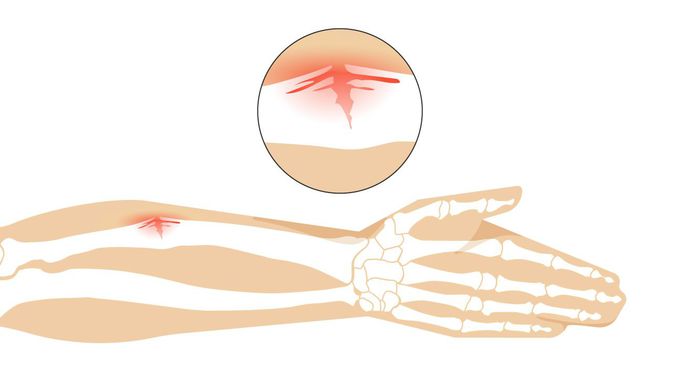 Cause of Greenstick Fracture