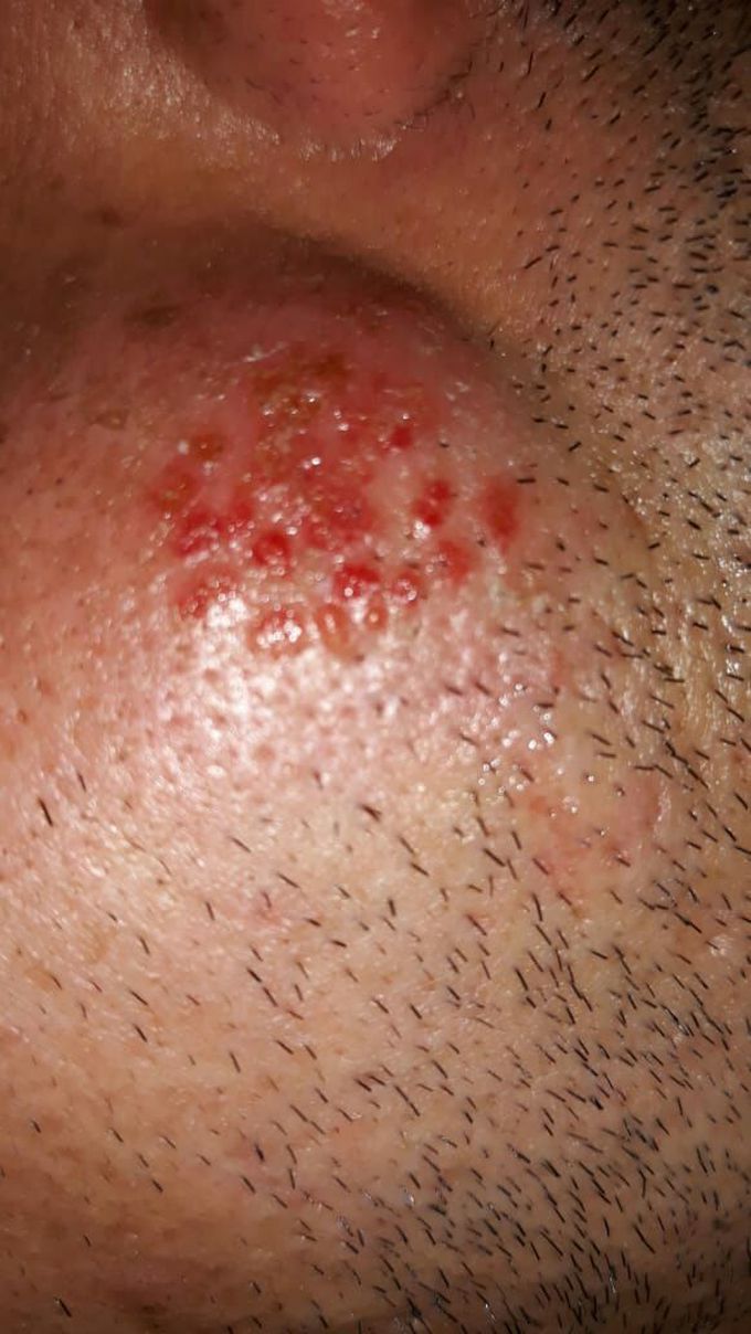 Dermatology