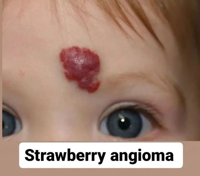 Strawberry Angioma
