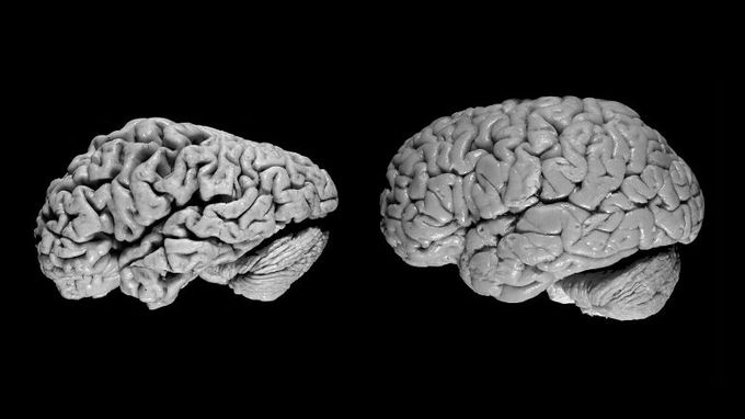 Brain atrophy in advanced Alzheimer's disease
