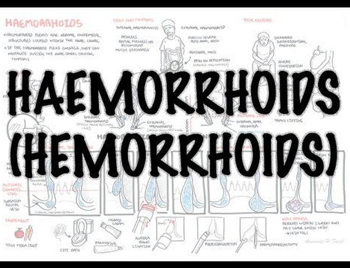 Haemorrhoids (Hemorrhoids) - Overview (pathophysiology, investigations and treatment)