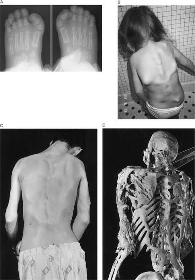 Fibrodysplasia ossificans