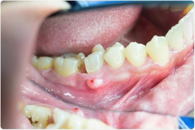 Treatment for dental abscess