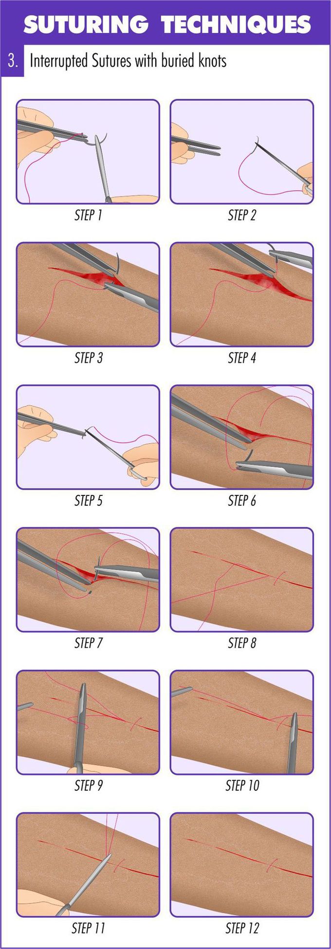 Complete Guide to Mastering Suturing Techniques | Medical education, Suture techniques, Medical knowledge