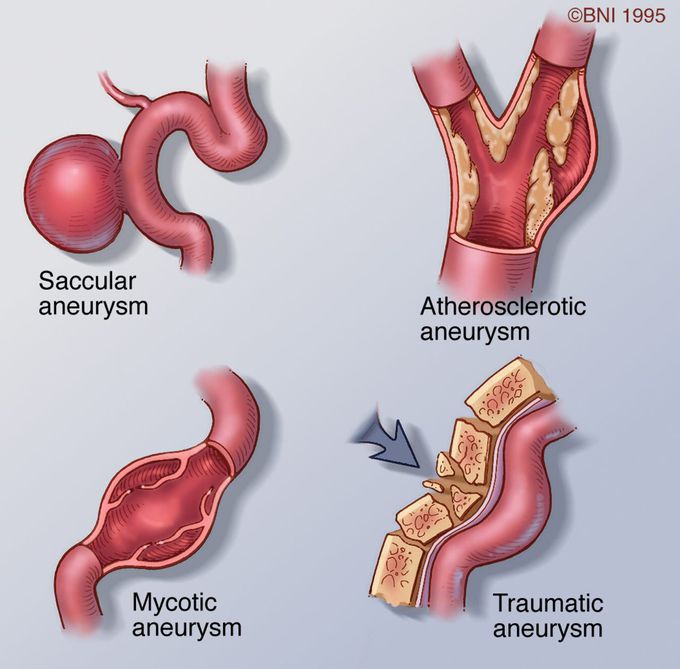 Aneurysms