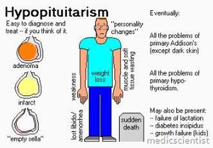 Hypopituitarism symptoms
