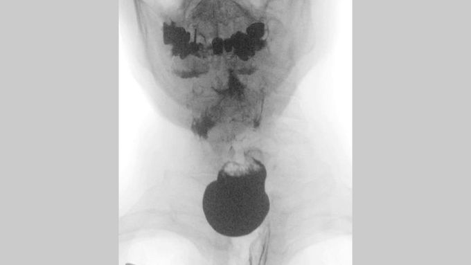 Swallowing Study For Zenker Diverticulum