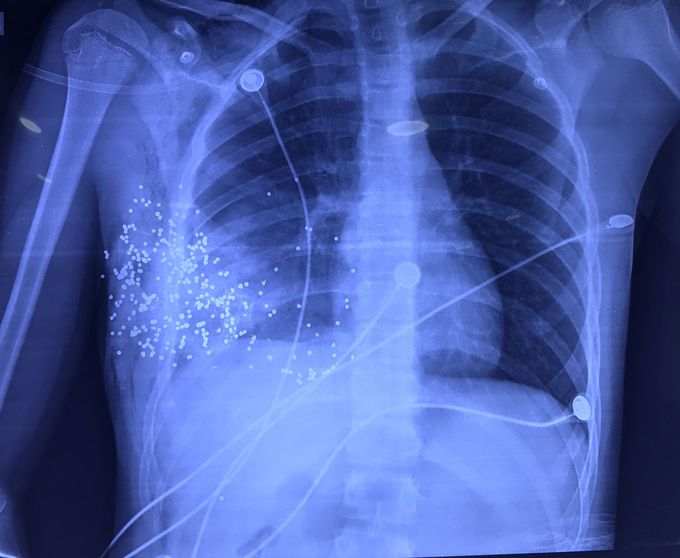 Xray of the chest