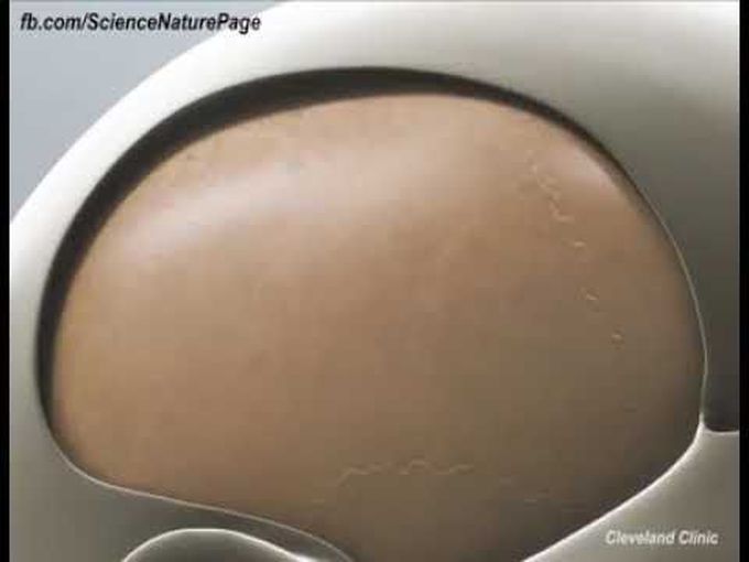 How surgeons remove brain tumors
