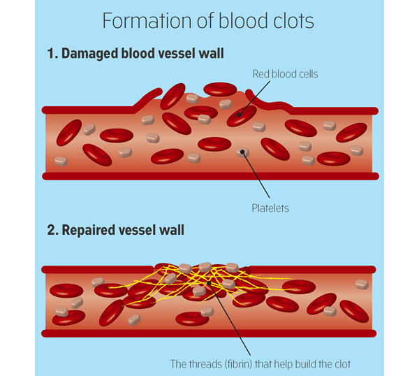 Blood clot MEDizzy