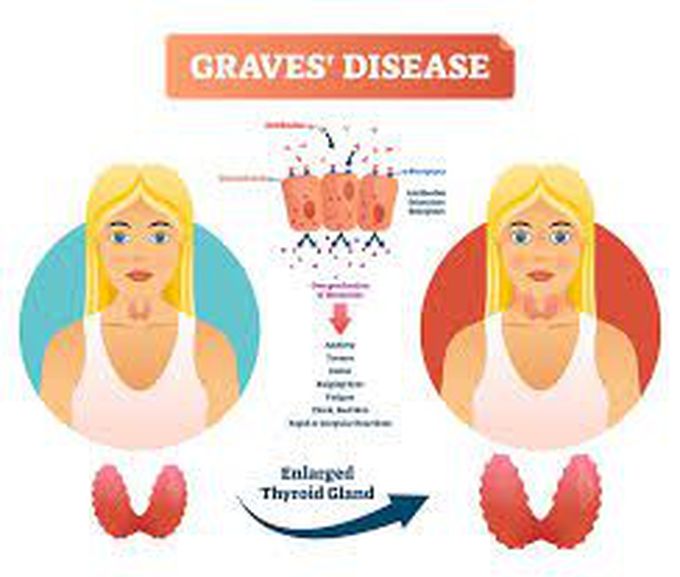 Causes of graves disease