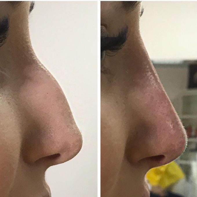 Medical Rhinoplasty