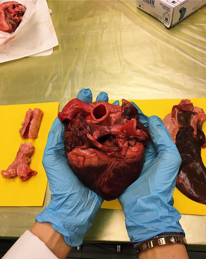 Heart and Aorta
