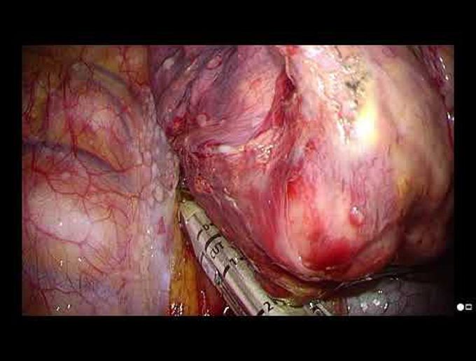 Full Thoracoscopic Right Basilar Segmentectomy for Carcinoid Tumor