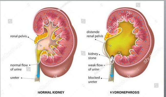 Normal Kidney Vs Hydronephrosis