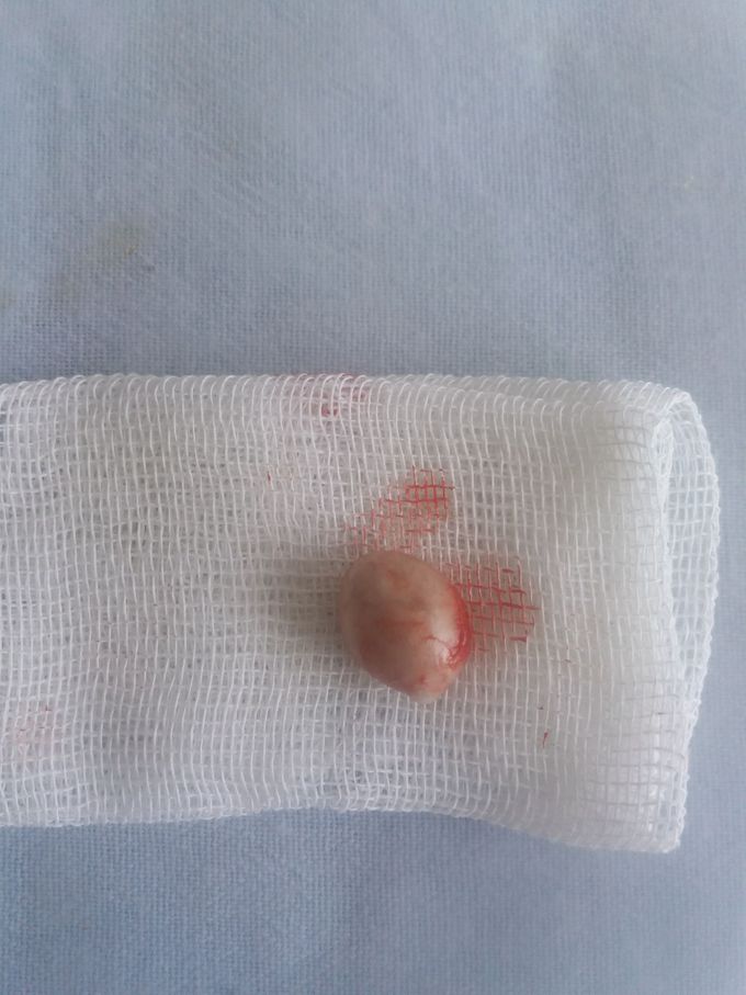 Lipoma