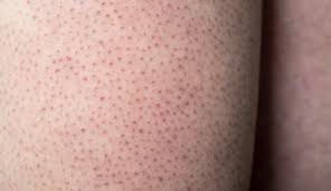 Keratosis Pilaris