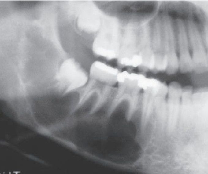 Traumatic bone cyst