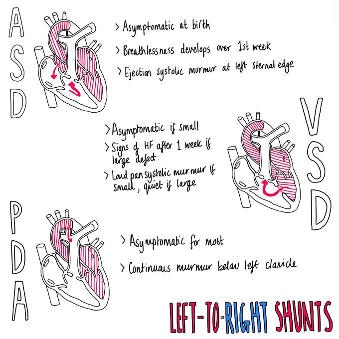 left-to-right-shunts-medizzy