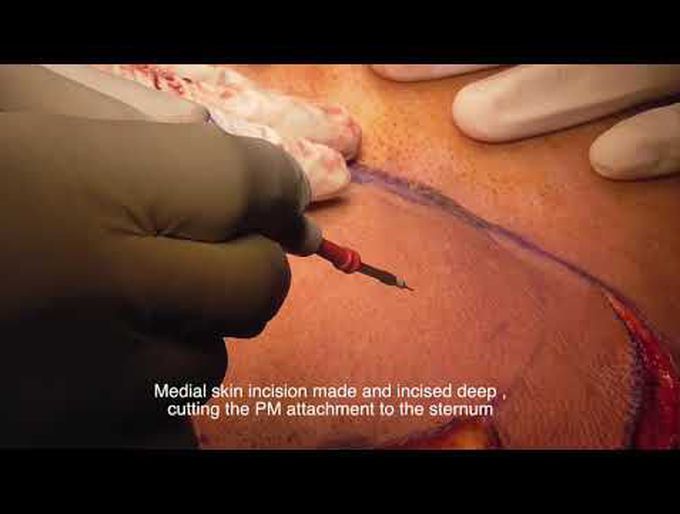 Pectoralis  major flap