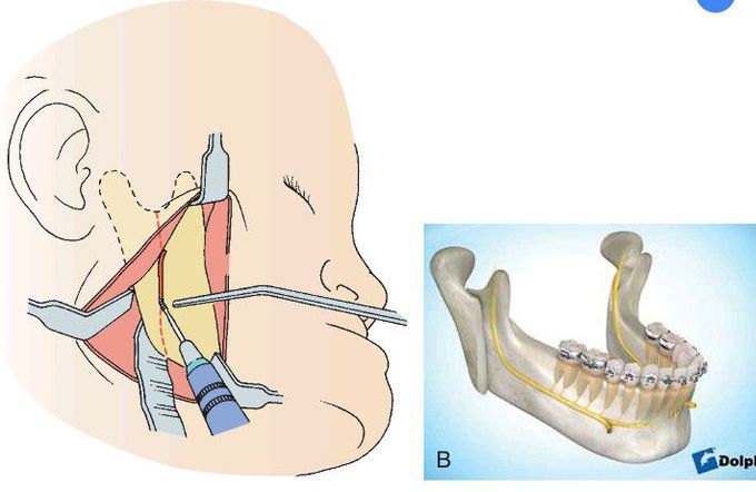 Extraoral approach for vertical ramus osteotomy