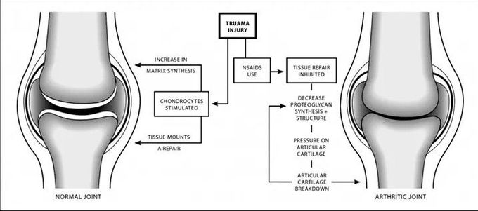 Difference between Normal & Arthritic joint