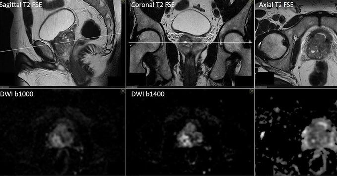 Multiparametric MR Imaging of the prostate gland