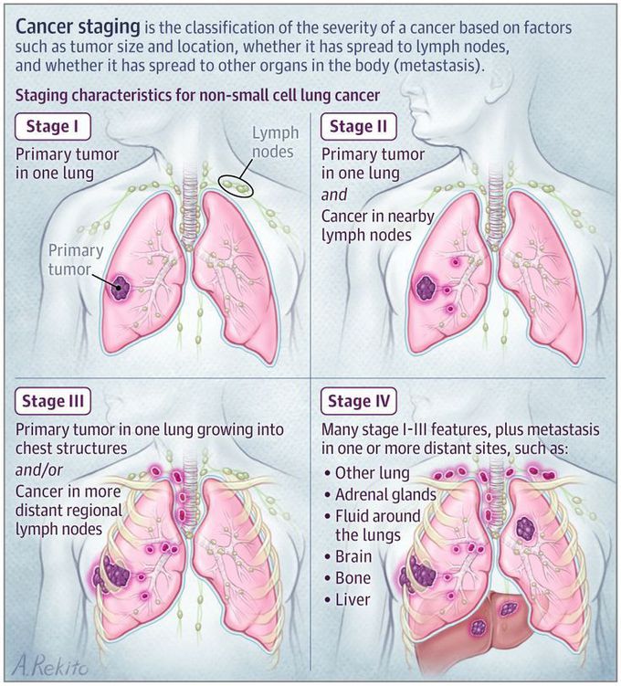 Cancer staging - MEDizzy