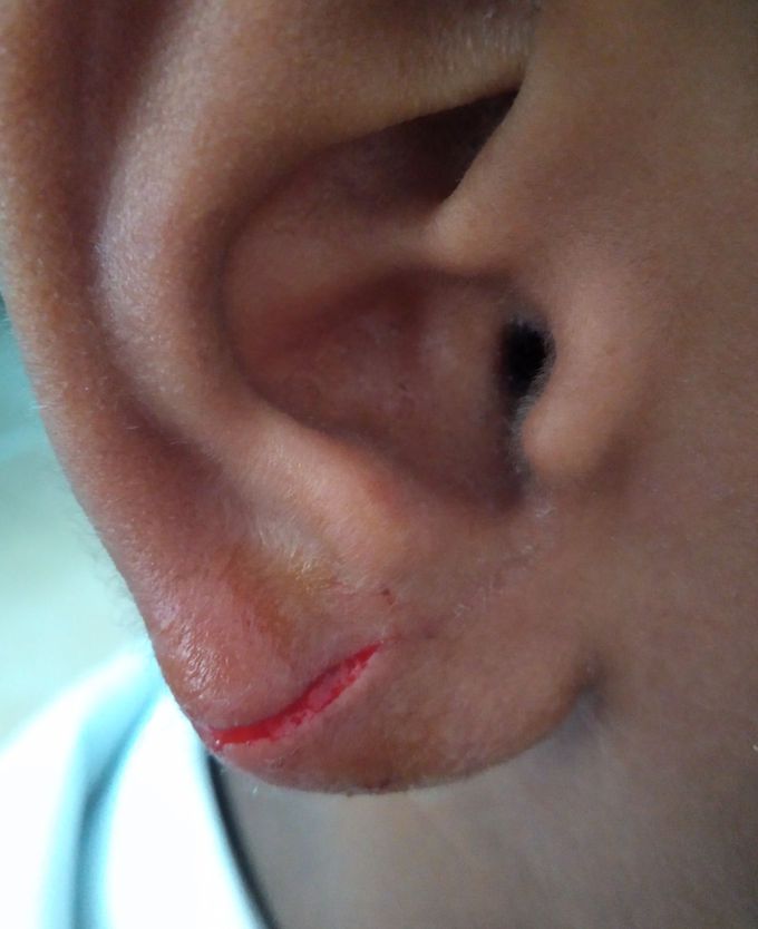 What do you think? Does this Child really needs Suturing?