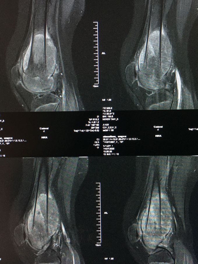 F 13y pain in rt knee this mri with contrast t1 fat sat sag