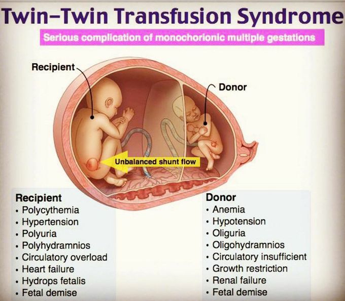 Twin-Twin Transfusion syndromes